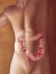 Diverticulitiszoom