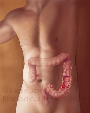 Diverticulitis-copyright