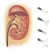 Endoscopekidney400