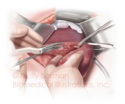 Liver-resection