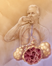 COPD-copyright