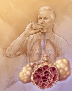 COPD-copyright