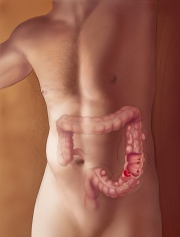 Diverticulitiszoom