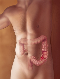 Diverticulitiszoom