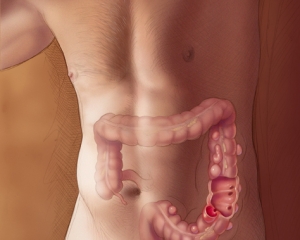 Diverticulitiszoom