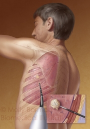 Lung-biopsy-copyright