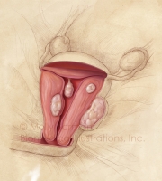 Uterine-Fibroids-copyright