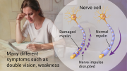 Multiple-Sclerosis-mbp-V3