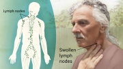 Non-Hodgkin's-Lymphoma_mbp_V2